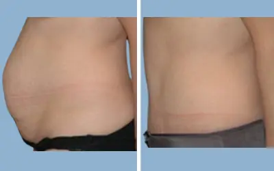 Before and After